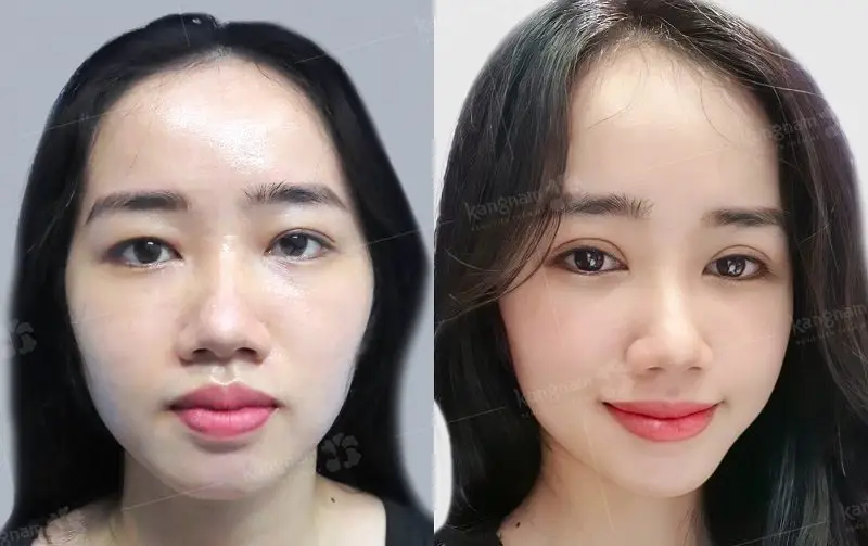 Sau nhấn mí khách hàng có thể cắt mí để khắc phục mọi khuyết điểm ở mắt