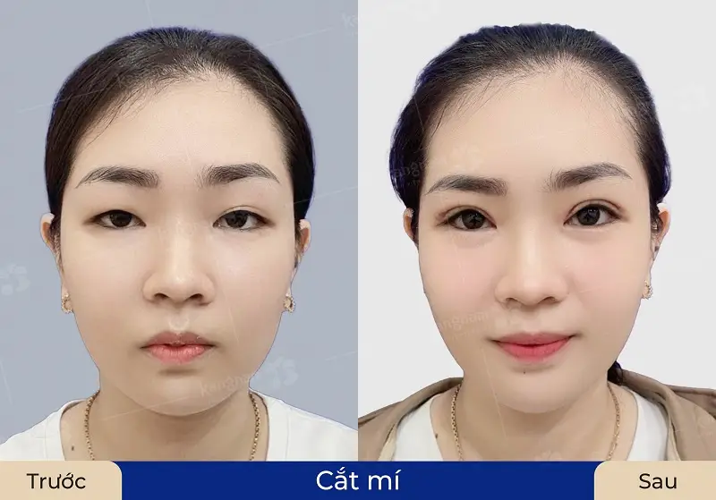 Mắt một mí, mí ẩn được cải thiện rõ rệt sau cắt mí