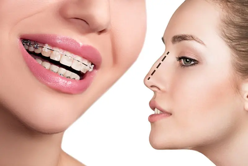 Đang niềng răng vẫn có thể nâng mũi