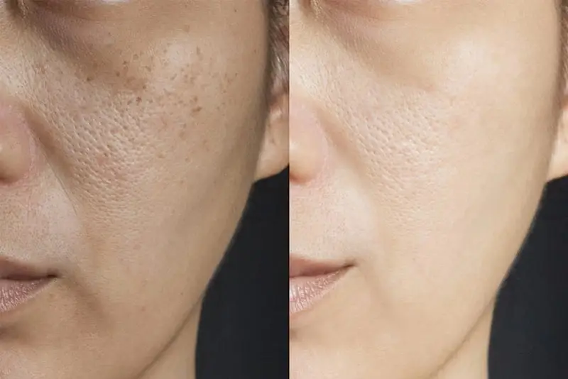 Nên chờ khi da ổn định mới tiêm meso