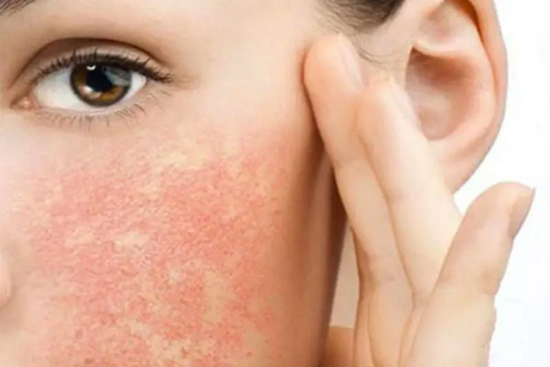 Tiêm meso quá sớm sau khi peel da có thể bị kích ứng