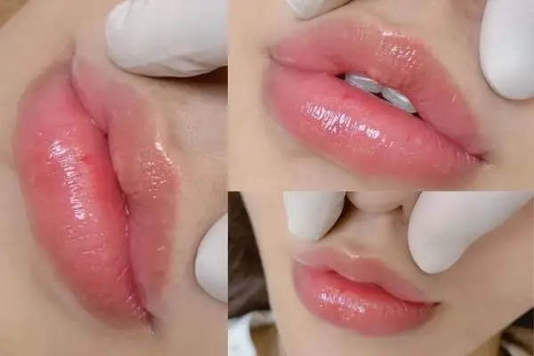 Môi căng mọng, quyến rũ sau khi tiêm filler