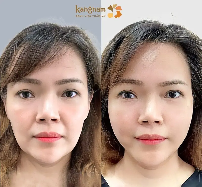 Vùng da mặt được căng bóng, đầy đặn sau tiêm filler