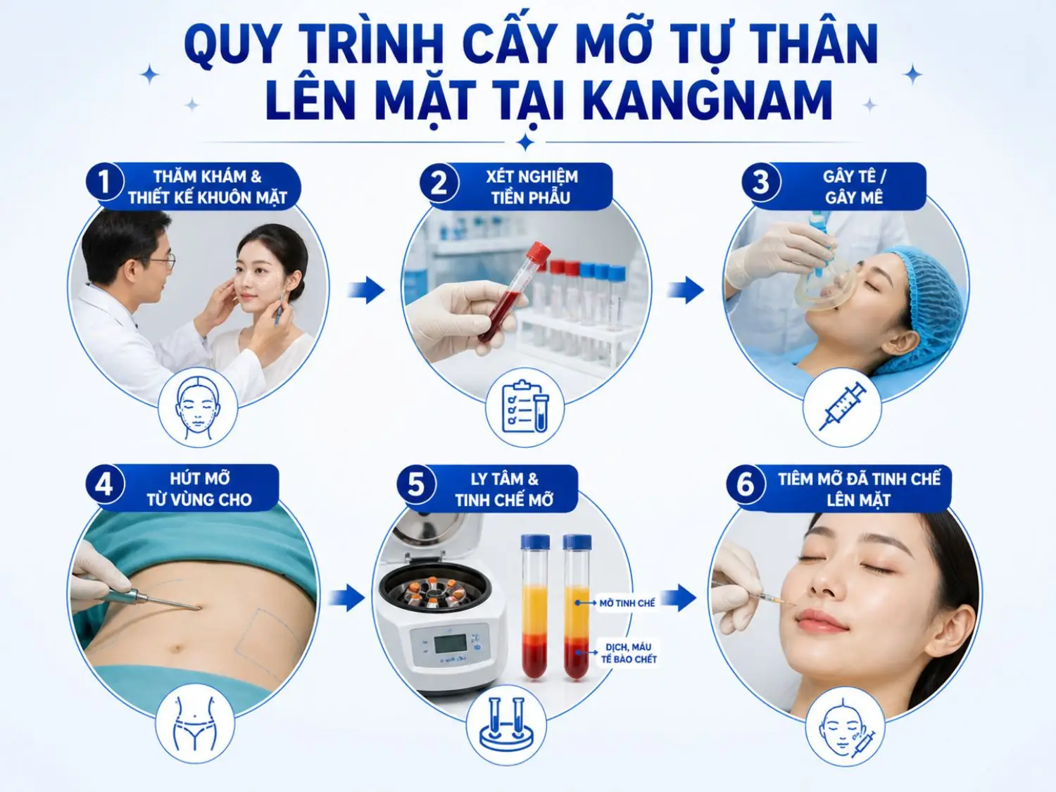 6 bước cấy mỡ tự thân chuẩn y khoa giúp đảm bảo an toàn và tăng tỷ lệ mỡ sống lâu dài