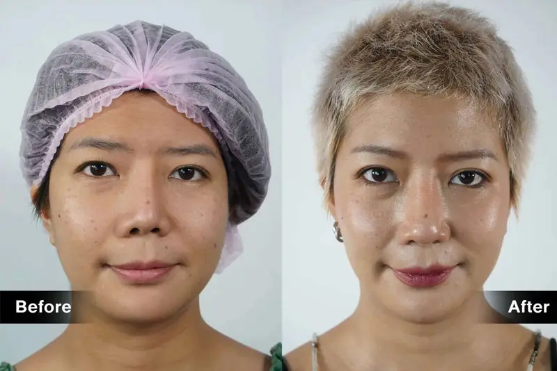 Nếu mũi lệch nhẹ, bác sĩ sẽ nắn chỉnh lại