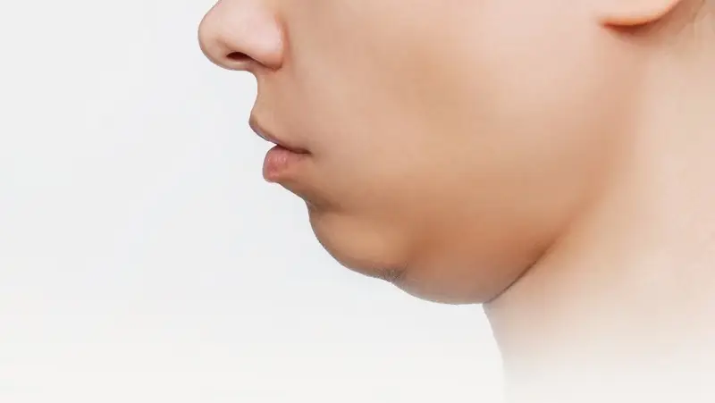 Mỡ nọng cằm hình thành chủ yếu do quá trình tăng hay giảm cân đột ngột