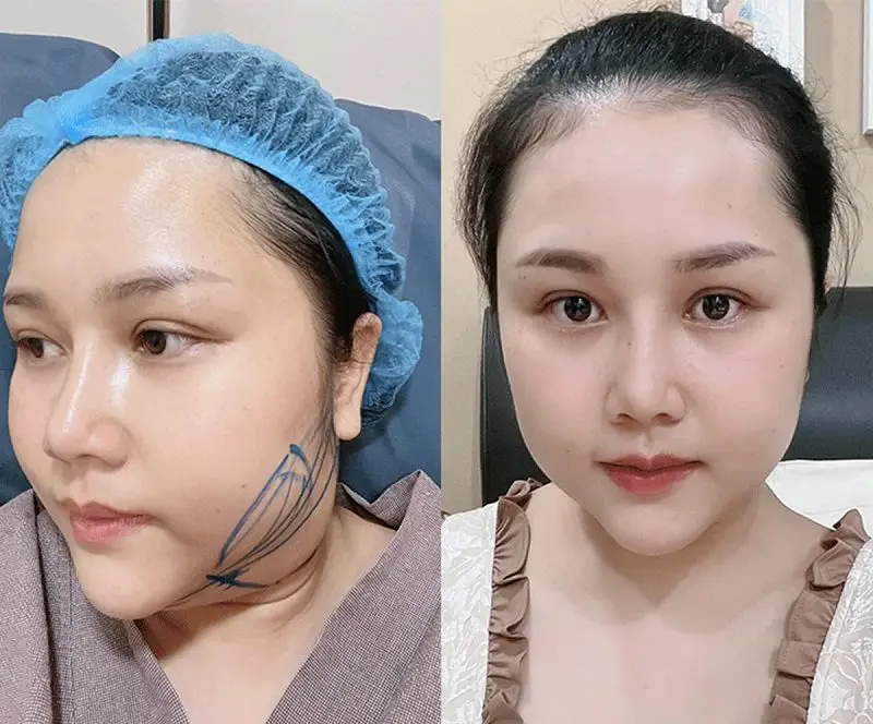 Hút mỡ nọng cằm sẽ giúp loại bỏ mỡ thừa nhanh chóng