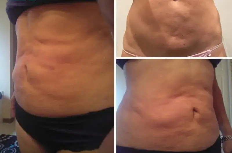 Hút mỡ bụng bị lồi lõm do còn dịch hoặc chất béo còn sót lại