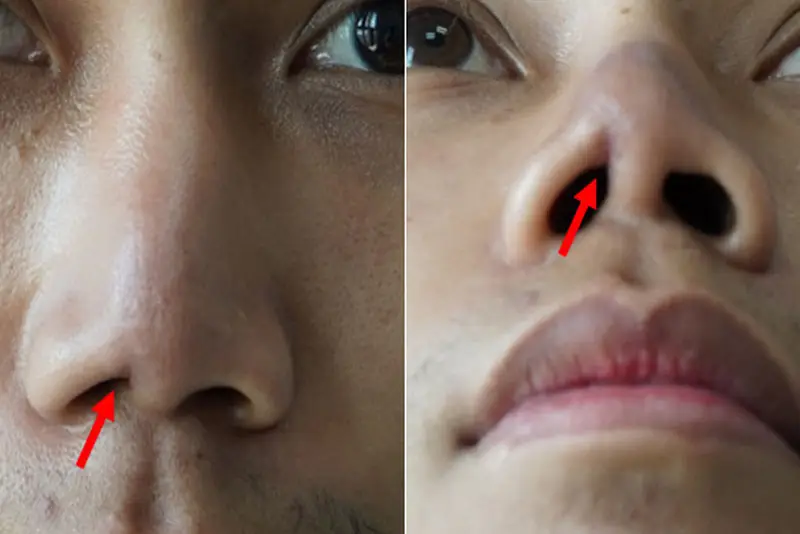 Biểu hiện mũi co rút sau phẫu thuật