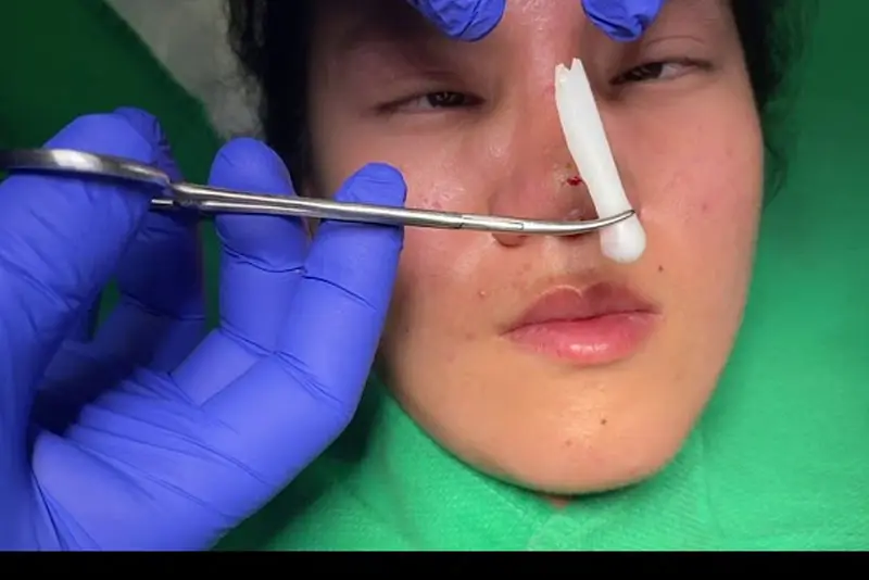 Rút sụn mũi cần thời gian hồi phục sau 2-3 tuần