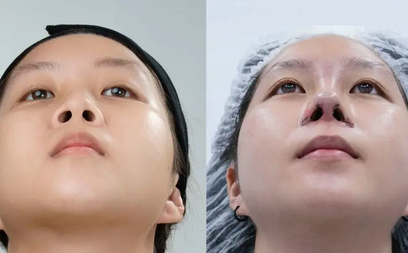 Thu gọn cánh mũi