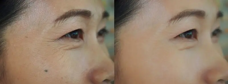 Người có nếp nhăn sâu, lão hóa nặng cần chi phí cao hơn