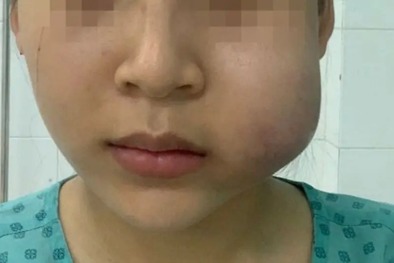 Tiêm filler sau 1 năm bị sưng là biến chứng nghiêm trọng
