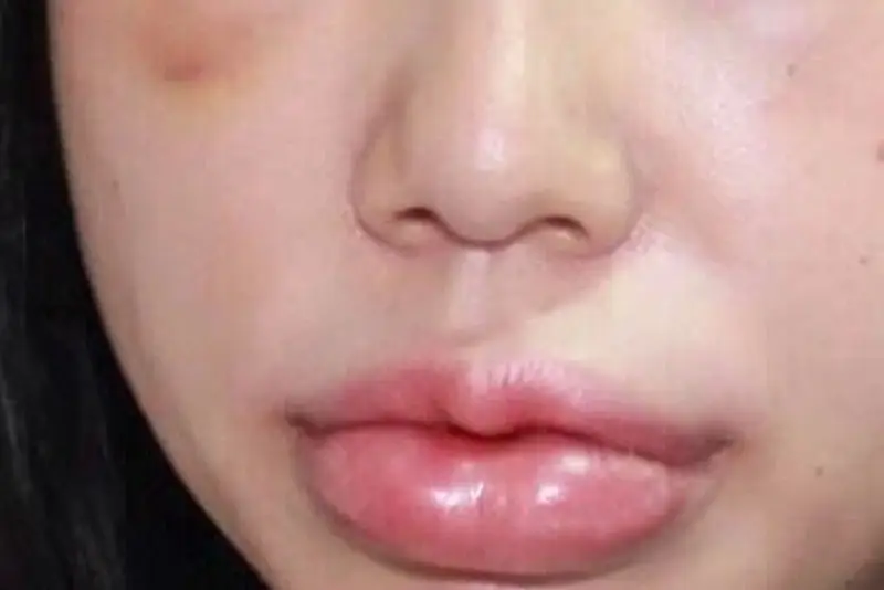 Tiêm filler môi bị sưng cần đặc biệt chú ý