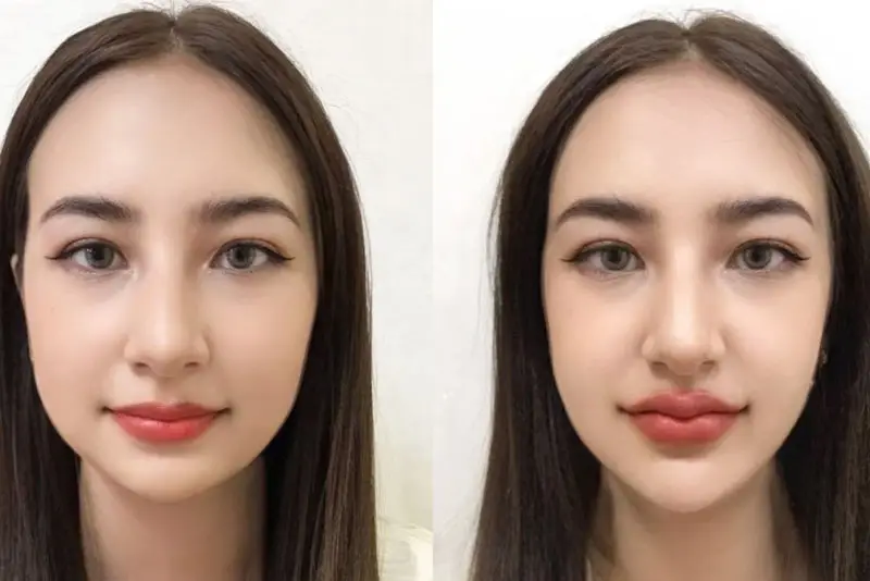 Nên chọn địa chỉ tiêm filler uy tín