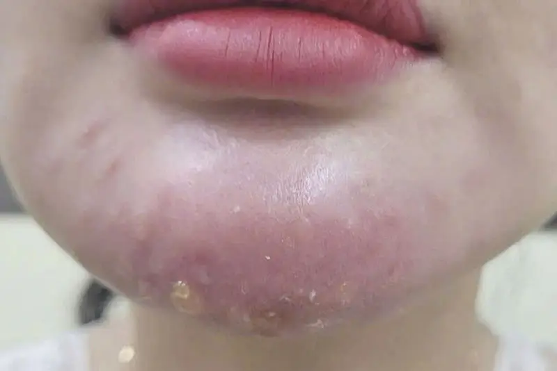 Tiêm filler cằm bị bầm tím do