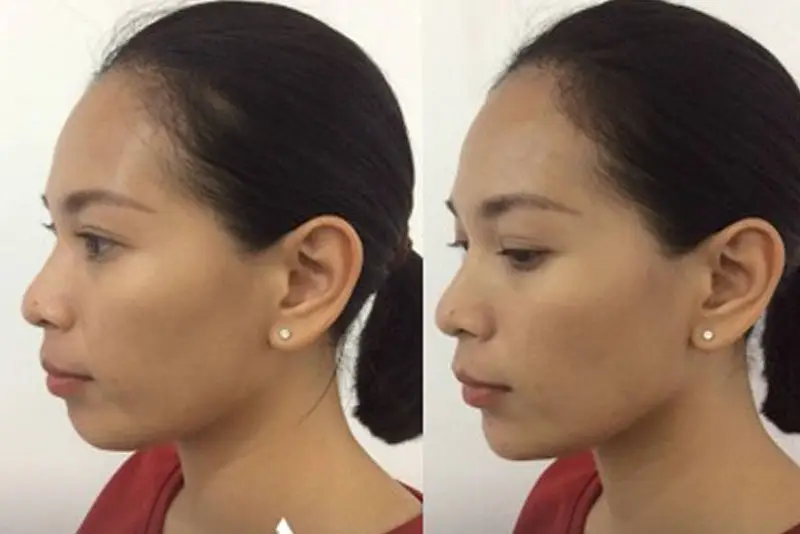 Tiêm filler cằm tạo dáng cằm đầy đặn, giúp gương mặt cân đối
