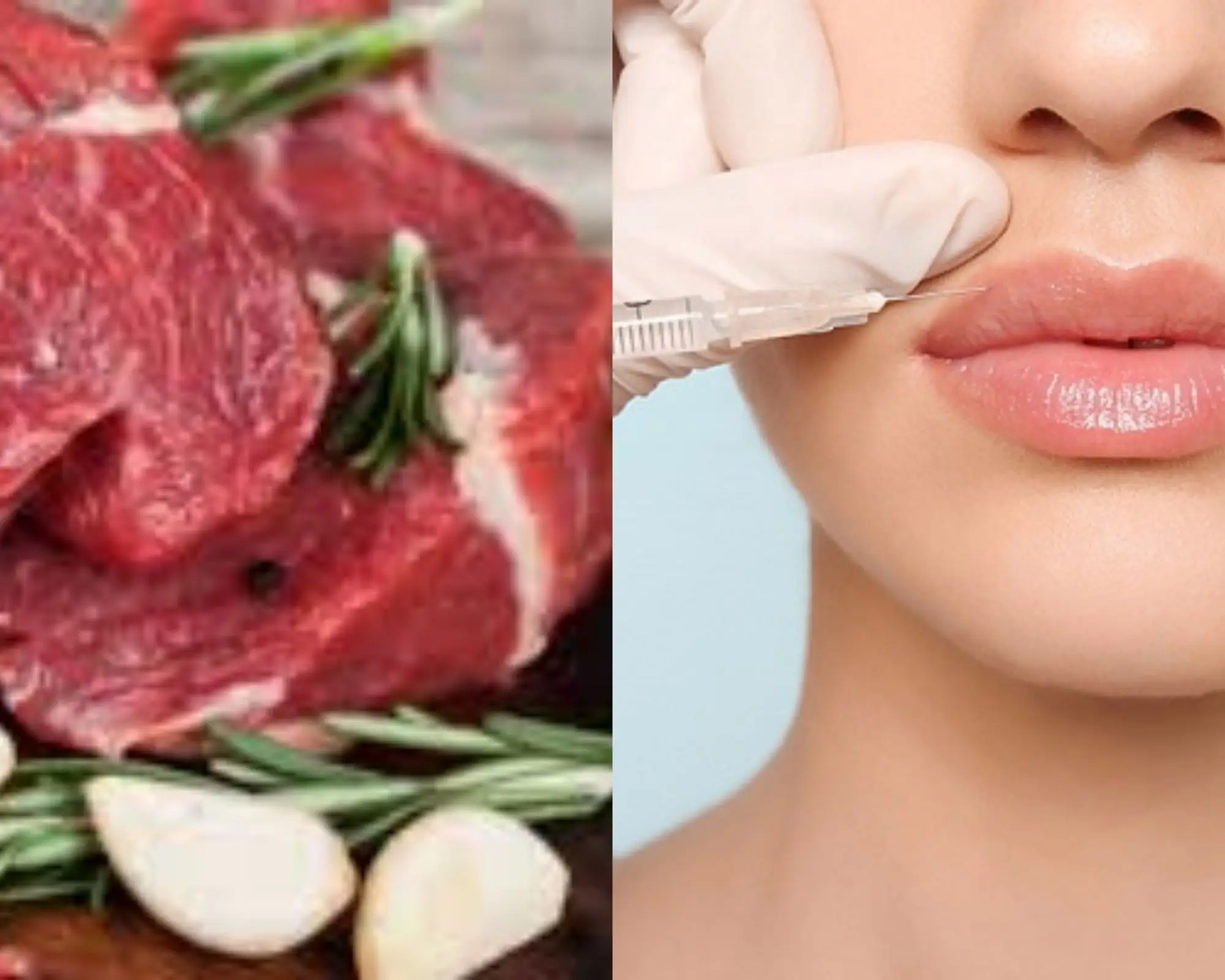 Kiêng thịt bò sau tiêm filler