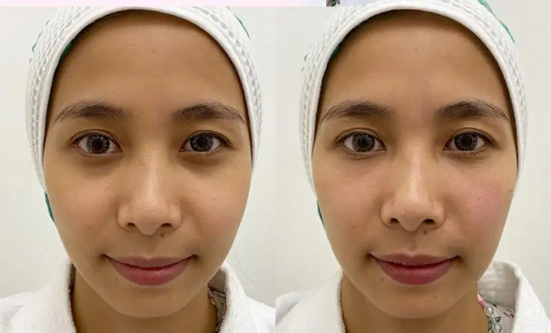 Làn da căng mịn hơn, các đường nét được điều chỉnh tinh tế