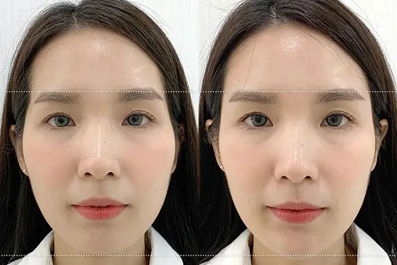 Khu vực được tiêm filler trở nên đầy đặn, cân xứng hơn