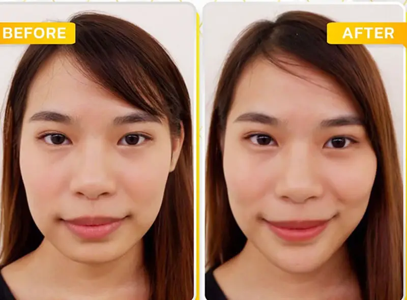 Gương mặt trở nên cân đối hơn, đường nét hài hòa