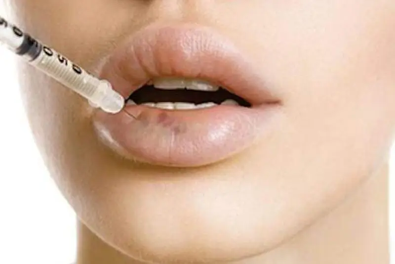 Tiêm steroid vào nốt cục