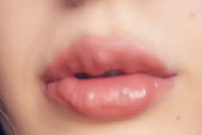 Tiêm filler môi bị vón cục