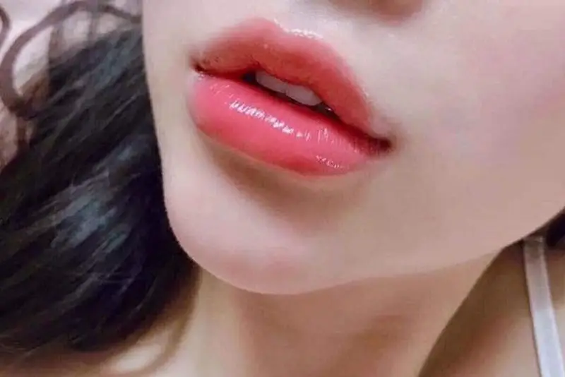 Môi sẽ hết sưng sau 24-48 giờ tiêm filler