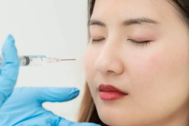 Tiêm filler mũi gây sưng do phản ứng viêm nhẹ của cơ thể với chất làm đầy