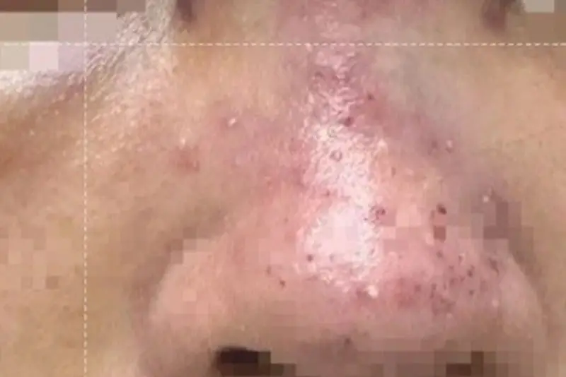 Tác hại khi tiêm filler mũi sai quy trình