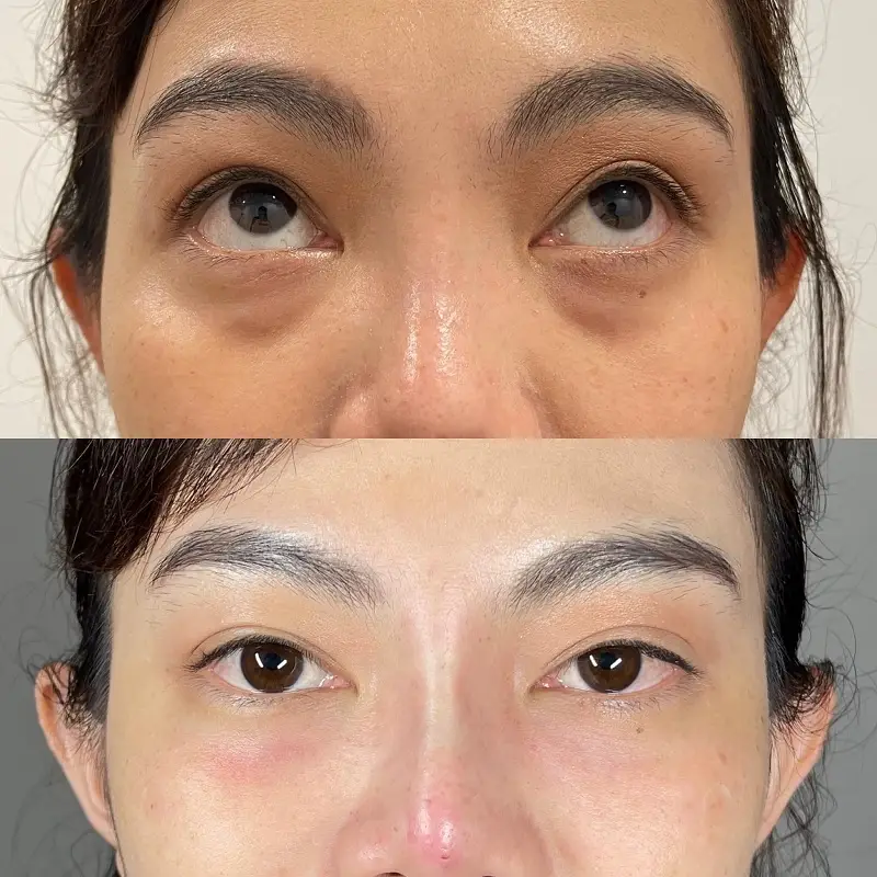 Đôi mắt của khách hàng tươi trẻ, rạng rỡ hơn