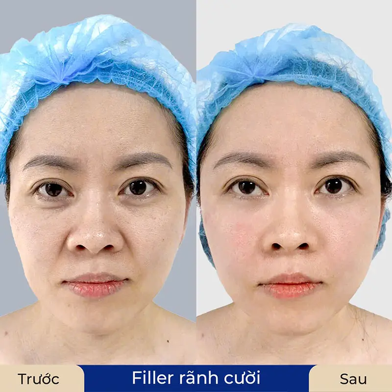Chỉ cần chờ đợi vài ngày, filler sẽ dần mềm và đẹp tự nhiên
