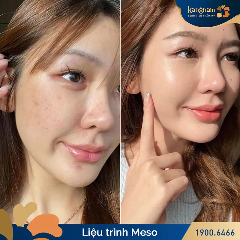 Da căng mọng, tươi trẻ sau tiêm meso