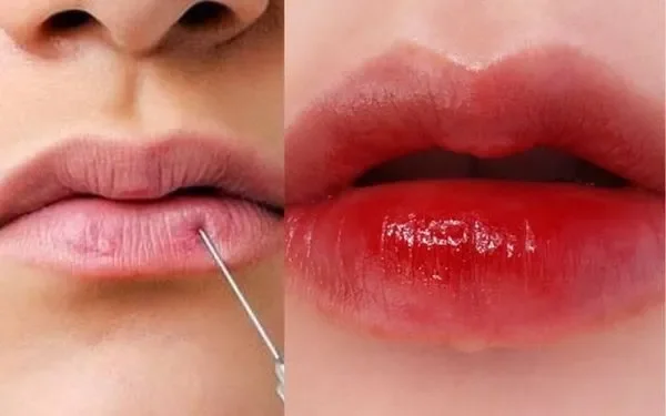 Lựa chọn cơ sở uy tín để đảm bảo kết quả tiêm filler môi tốt nhất