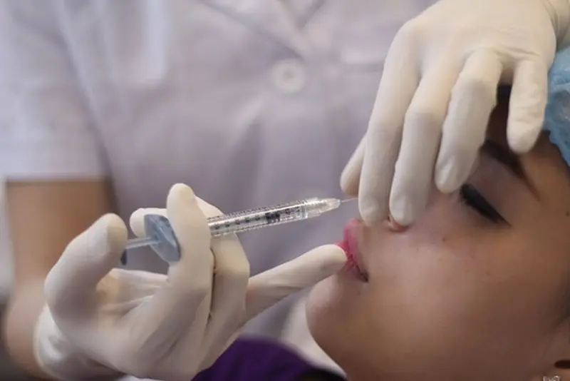 Tiêm nâng mũi bằng filler là phương pháp không "dao kéo"