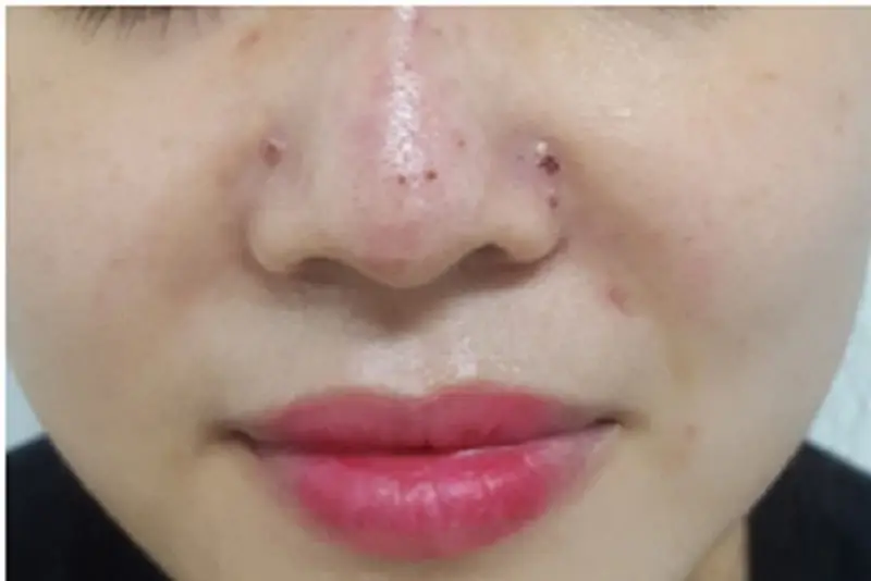 Tiêm filler nâng mũi nếu sai kỹ thuật có thể gây tắc mạch