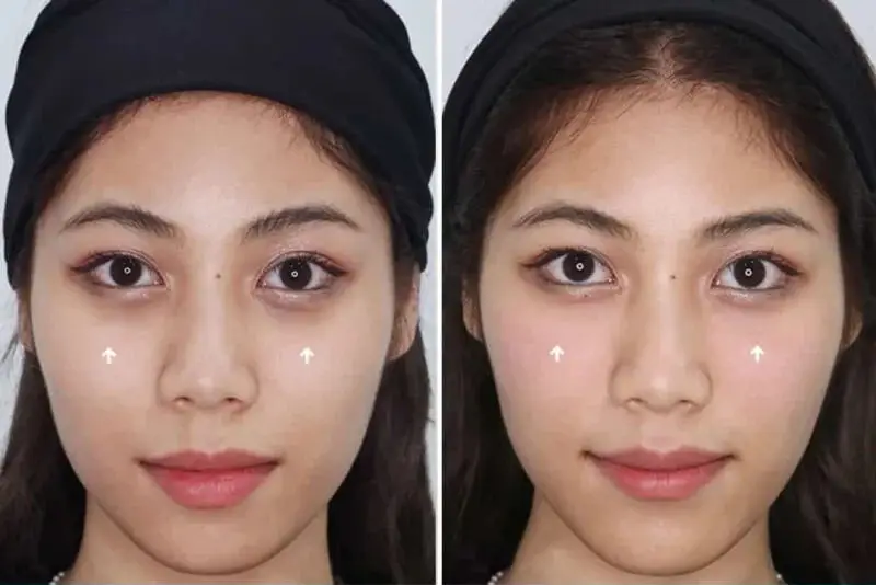 Tiêm filler trị quầng thâm mắt duy trì 6 - 24 tháng