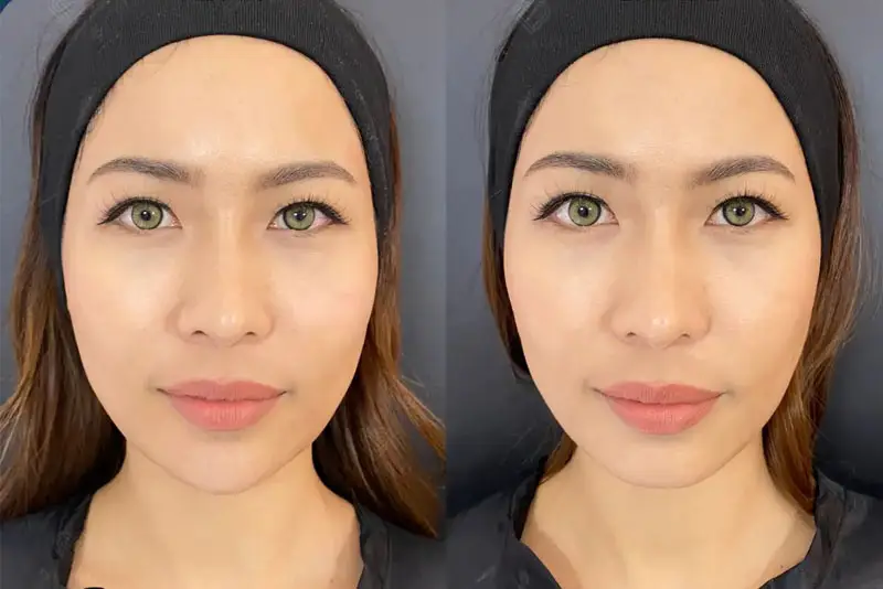 Tiêm tan filler cằm, dáng cằm trở về hình dạng tự nhiên