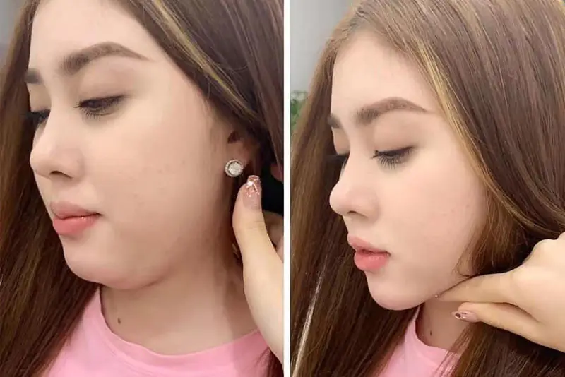 Cách chăm sóc sau tiêm tan mỡ mặt ảnh hưởng đến kết quả