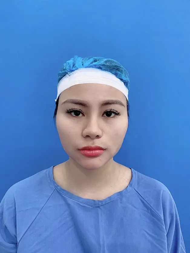 Gò má cao do xương cần phẫu thuật chứ không tiêm được