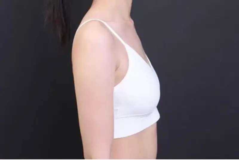 16 tuổi ngực lép do nhiều nguyên nhân