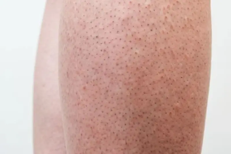 Triệt lông sớm gây viêm nang lông