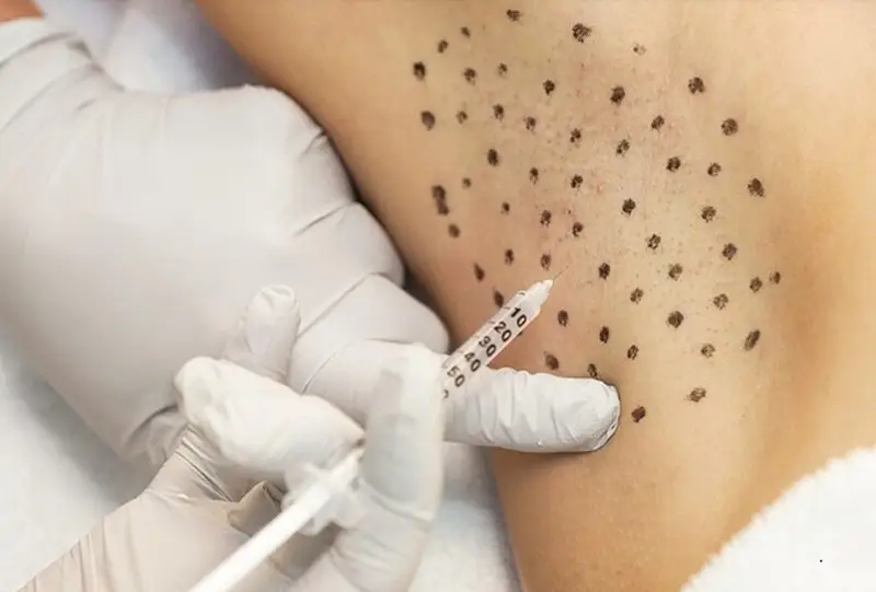 Tiêm botox có tác dụng làm giảm mùi mồ hôi nách