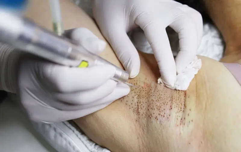 Sử dụng tia laser có cường độ cao để loại bỏ tuyến mồ hôi