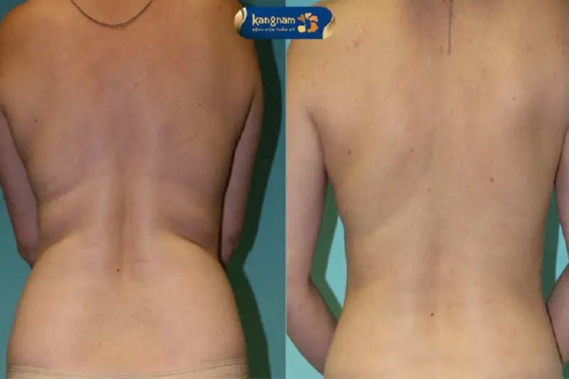 Hút mỡ là cách giảm mỡ lưng và vai mang lại hiệu quả nhanh