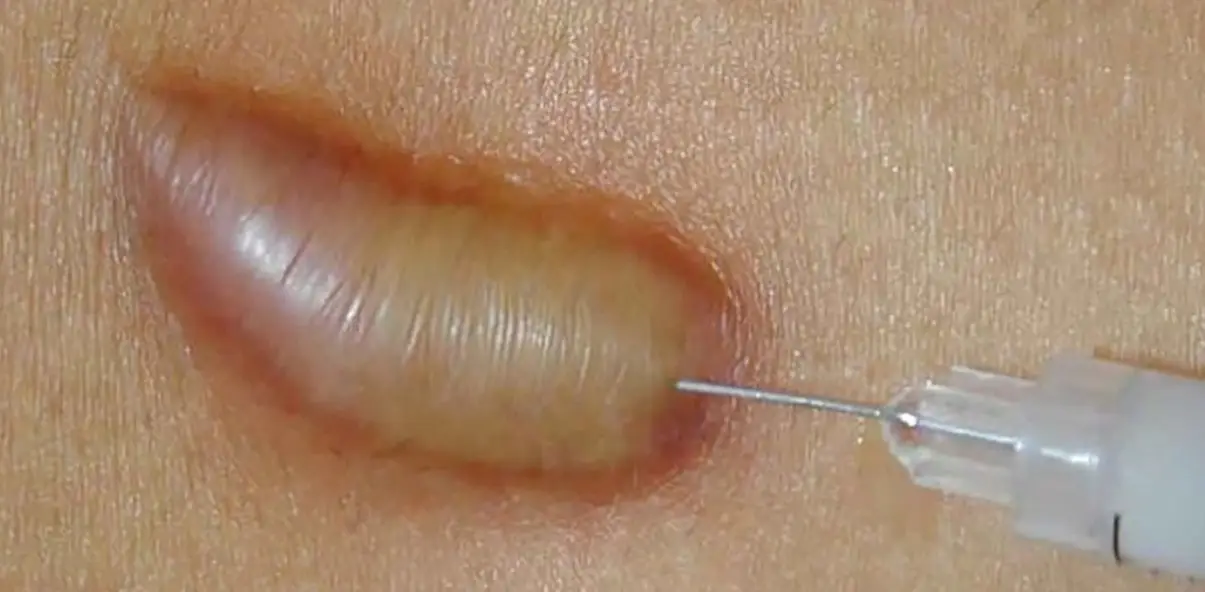 Tiêm corticosteroid giúp làm phẳng vùng da bị sẹo