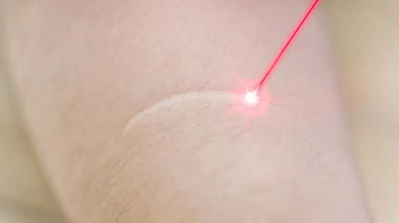 Điều trị bằng Laser sử dụng năng lượng để loại bỏ sẹo