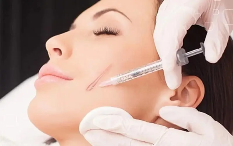 Cách trị sẹo lồi trên mặt bằng phương pháp tiêm corticoid phù hợp với trường hợp sẹo nhỏ
