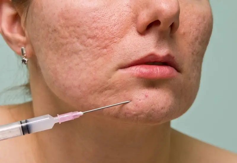 Tiêm chất làm đầy để lấp những vùng da bị thiếu hụt do sẹo