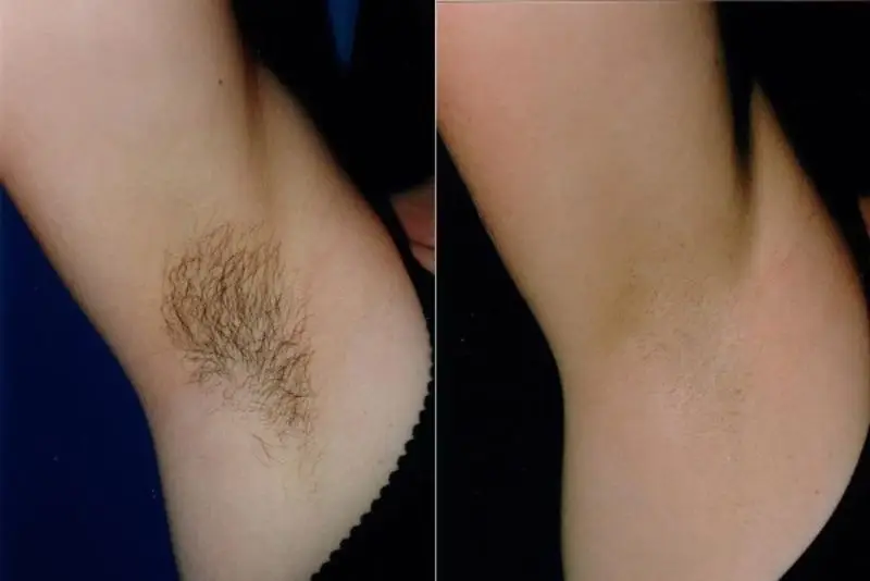 Triệt lông nách tại nhà an toàn, nhanh chóng